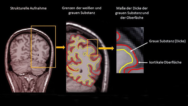 Bilder eines Gehirns, die mit einem Kernspintomographen erstellt wurden