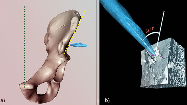3D-Modell eines Beckenknochens
